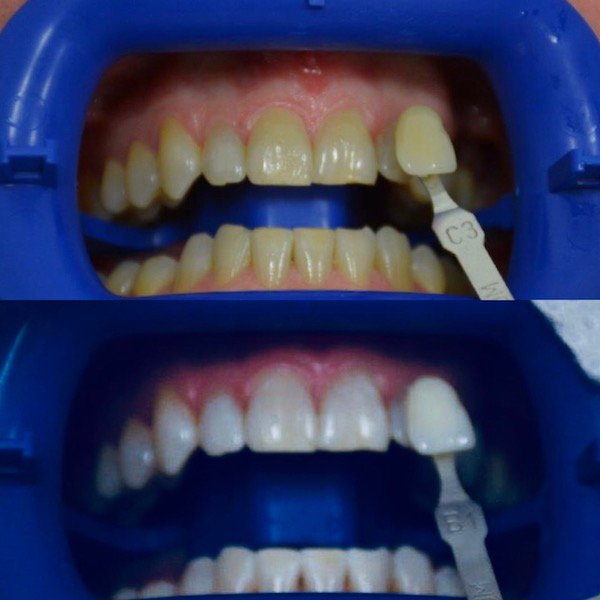Teeth whitening dentist Buderim