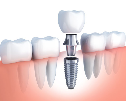 Dental Implants Advantages And Disadvantages