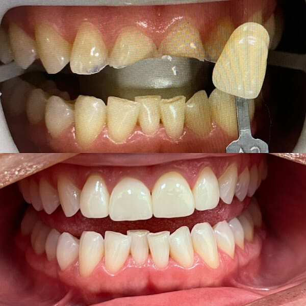 before and after image of crown in buderim