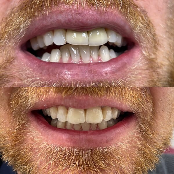 before and after image of crown