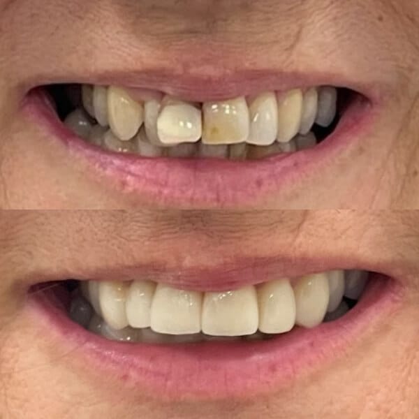 before after image invisalign buderim