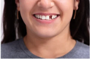 Broken or Knocked-Out Tooth