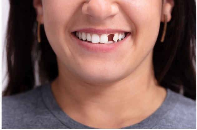 Broken or Knocked-Out Tooth